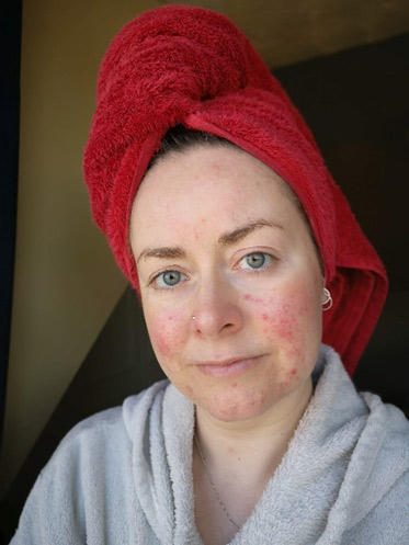 girl with redness from living with rosacea