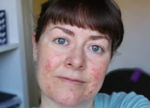ROSACEA, this subject is very close to my own heart.
