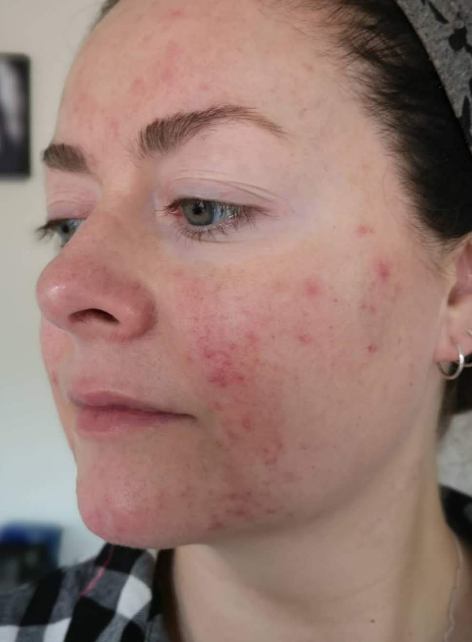 living with rosacea, 