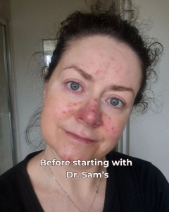 Dr. Sam's skincare - rosacea solution