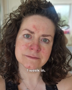 Dr. Sam's skincare - rosacea solution