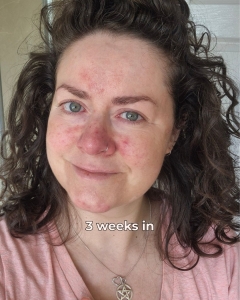 Dr. Sam's skincare - rosacea solution