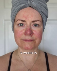 Dr. Sam's skincare - rosacea solution